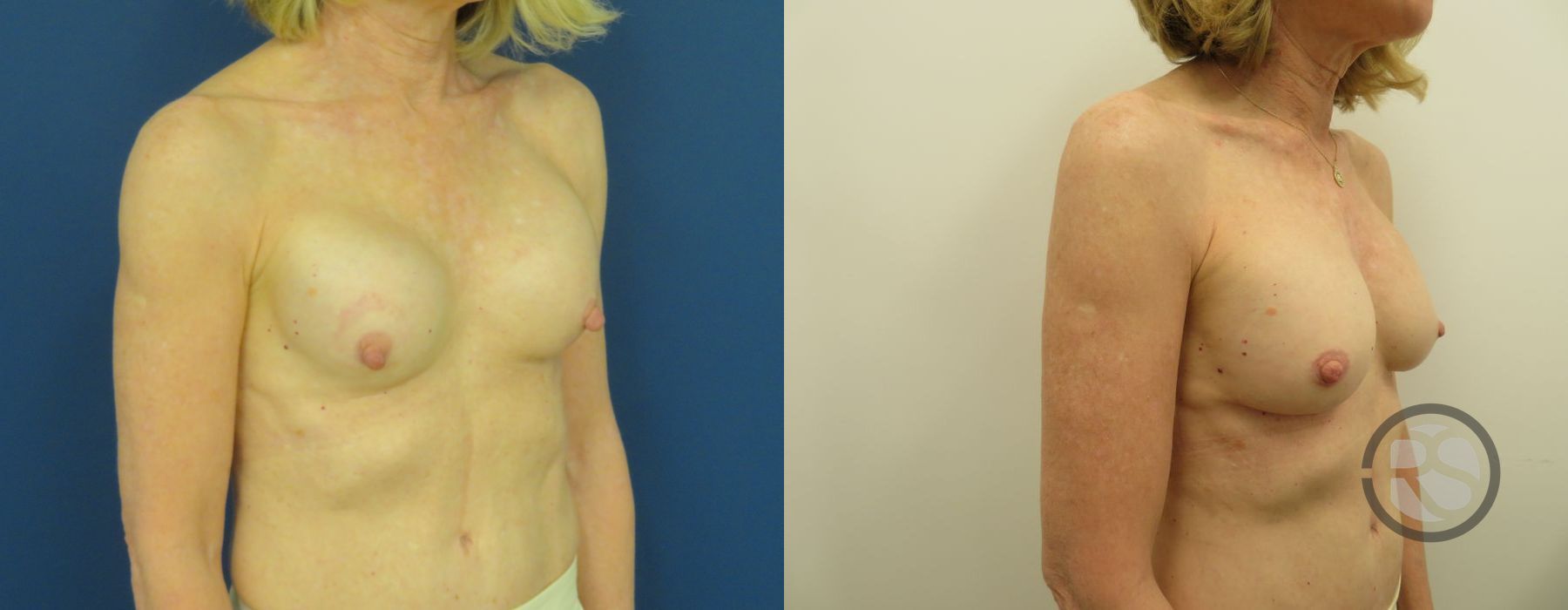 Before photo - Angle 3