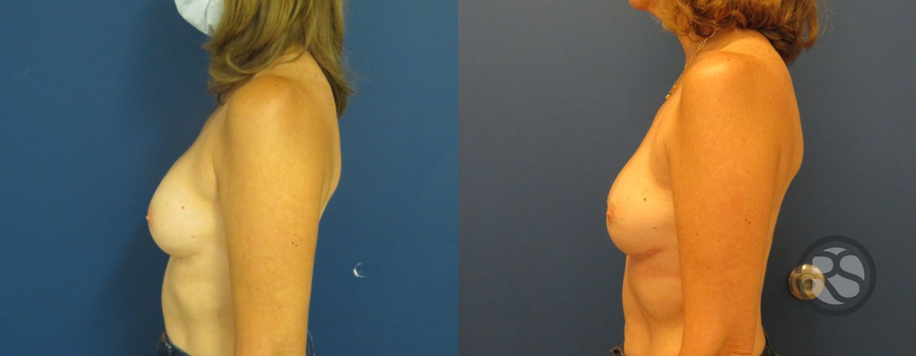 Before photo - Angle 5