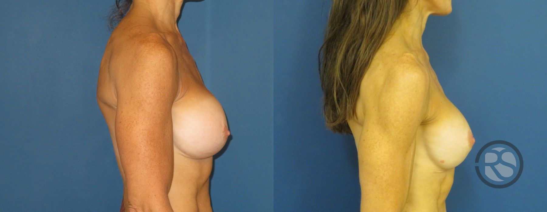 Before photo - Angle 3