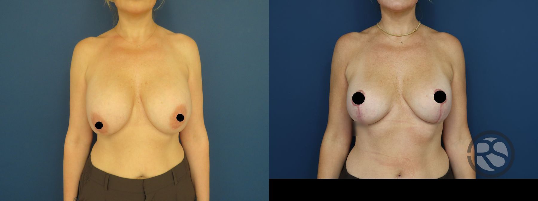 Before and after Revision Breast Augmentation Mastopexy case 49895