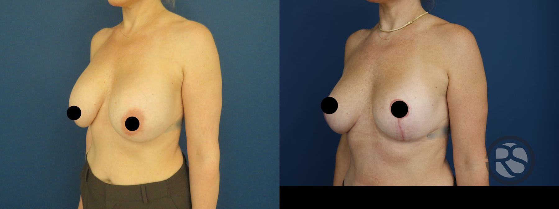 Before and after Revision Breast Augmentation Mastopexy case 49895 - Angle 4