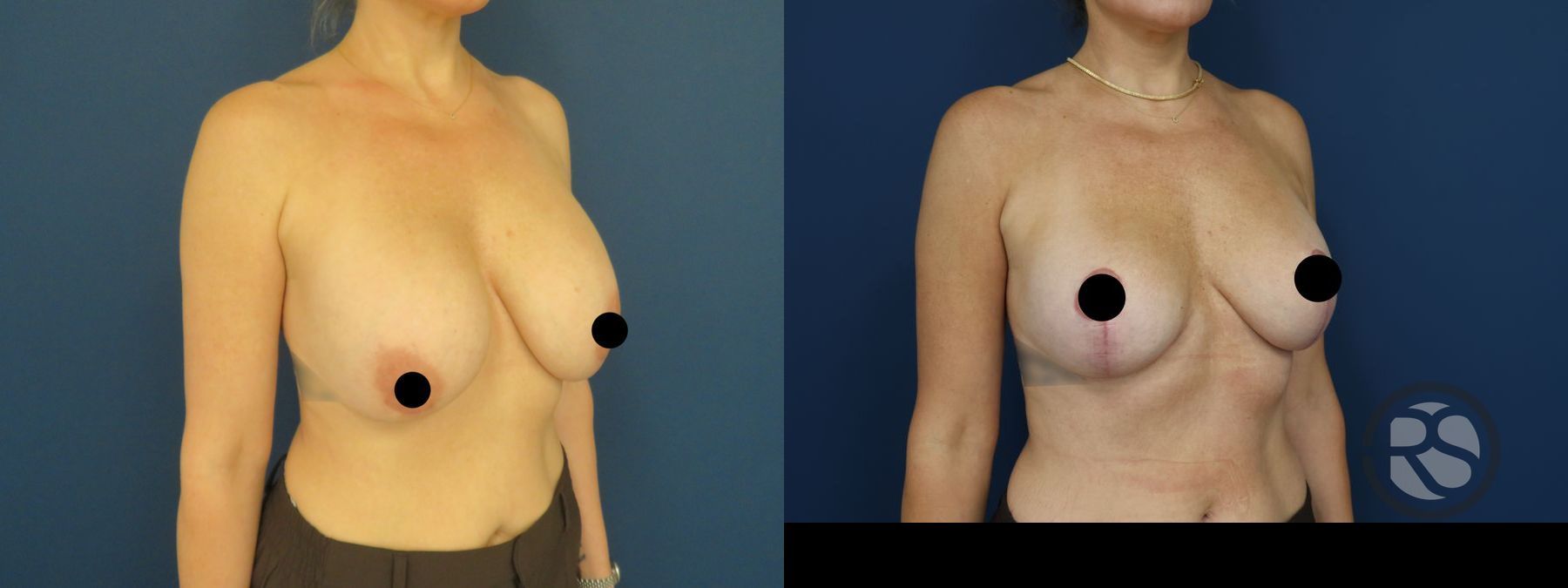 Before and after Revision Breast Augmentation Mastopexy case 49895 - Angle 3
