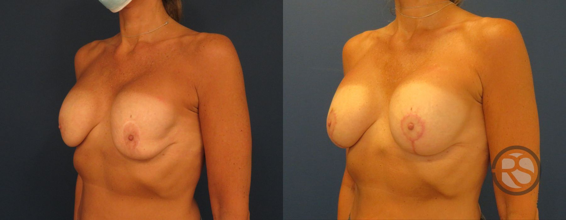 Before photo - Angle 4