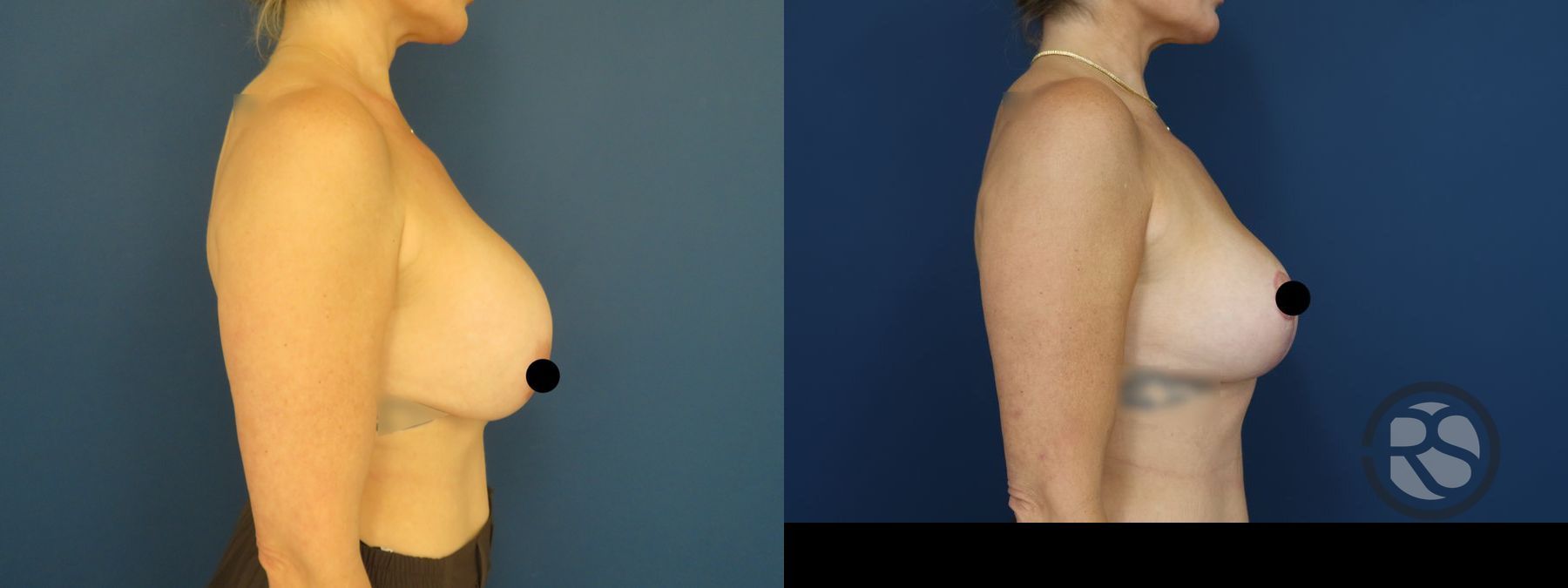 Before and after Revision Breast Augmentation Mastopexy case 49895 - Angle 2