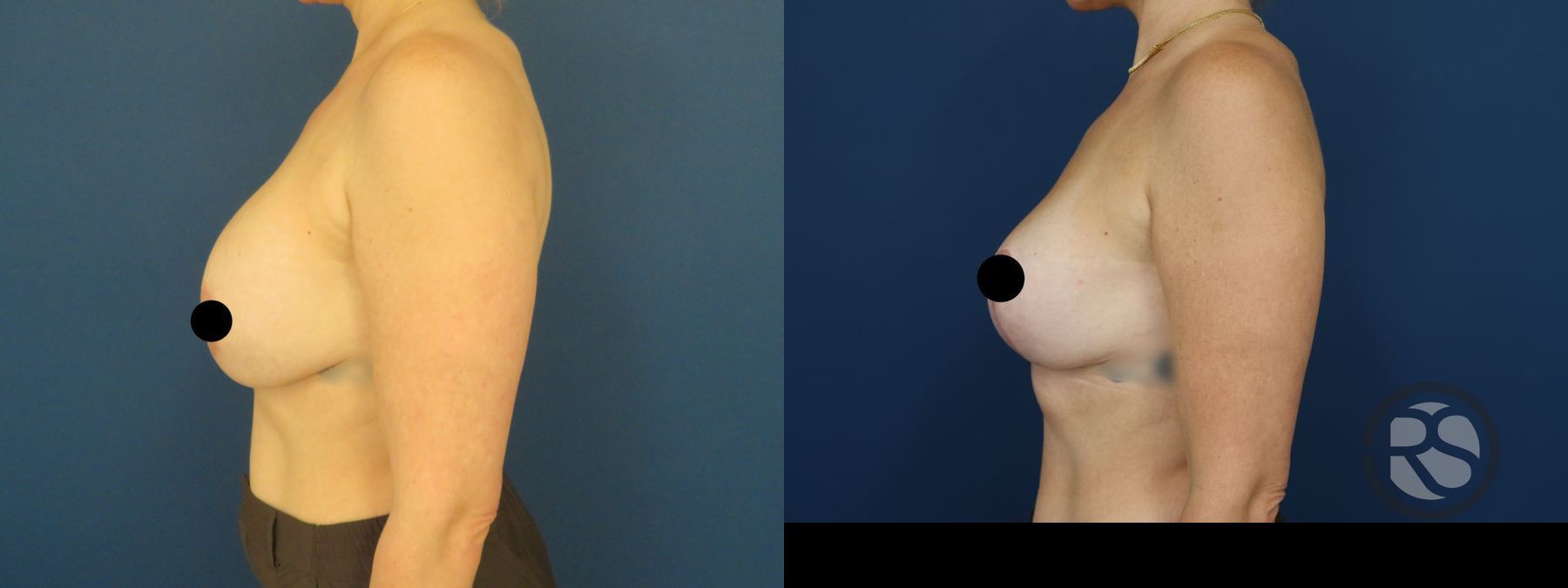 Before and after Revision Breast Augmentation Mastopexy case 49895 - Angle 5