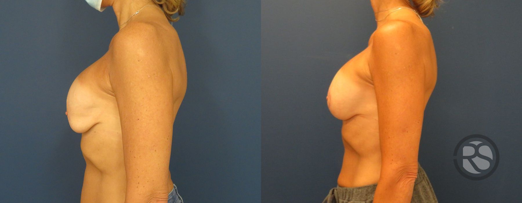 Before photo - Angle 5