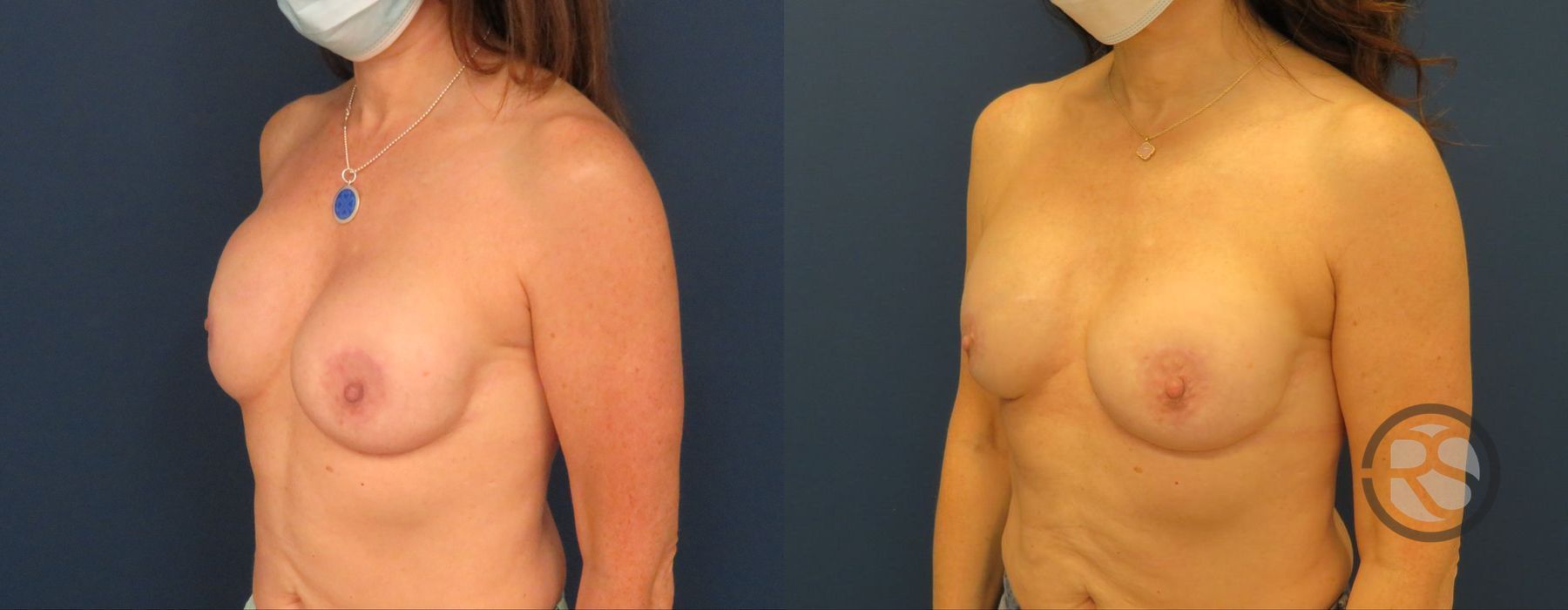 Before photo - Angle 4