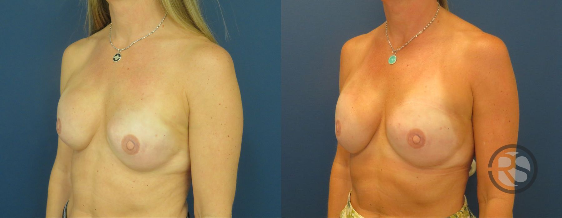 Before photo - Angle 4