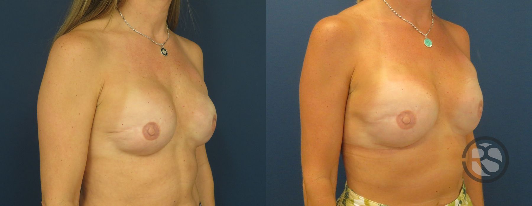 Before photo - Angle 2