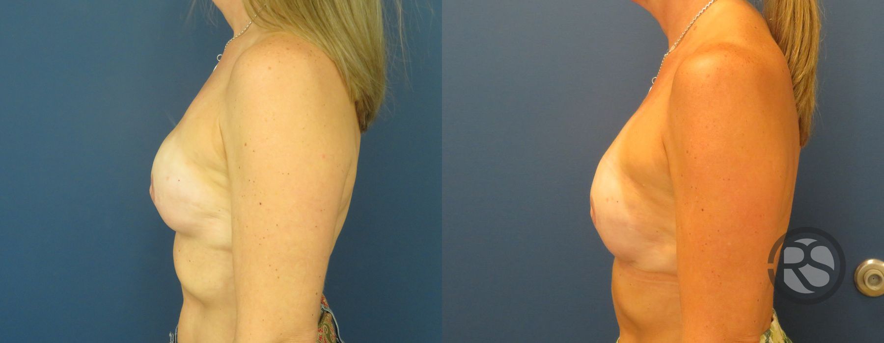 Before photo - Angle 5