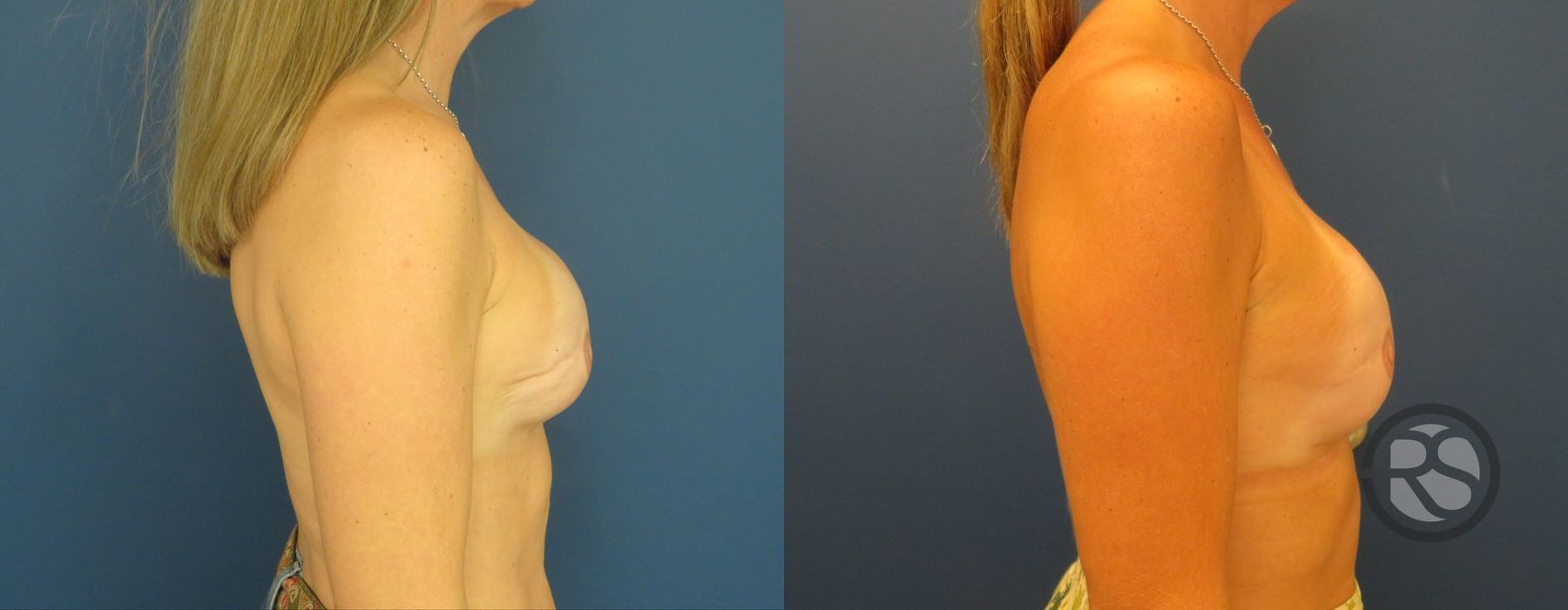 Before photo - Angle 3