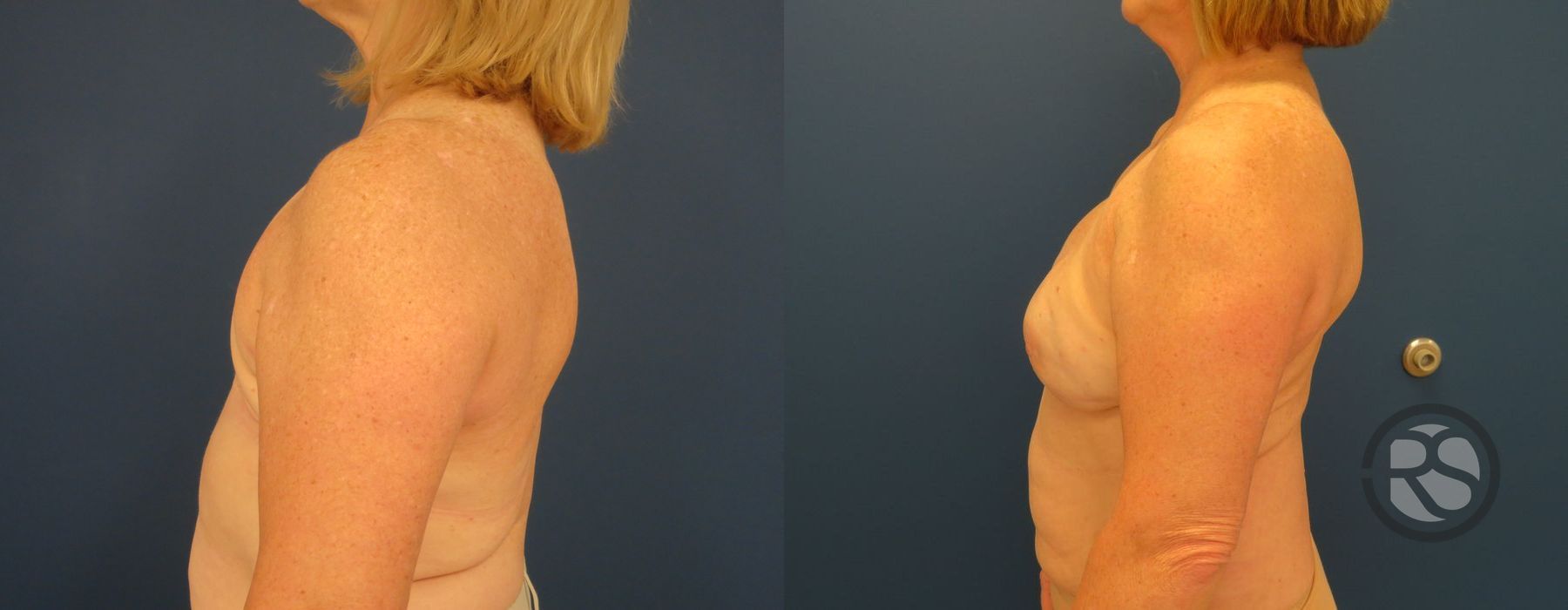 Before photo - Angle 3