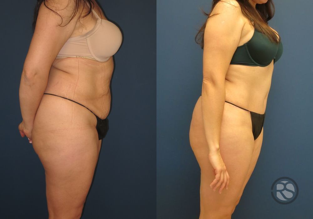 Before photo - Angle 3