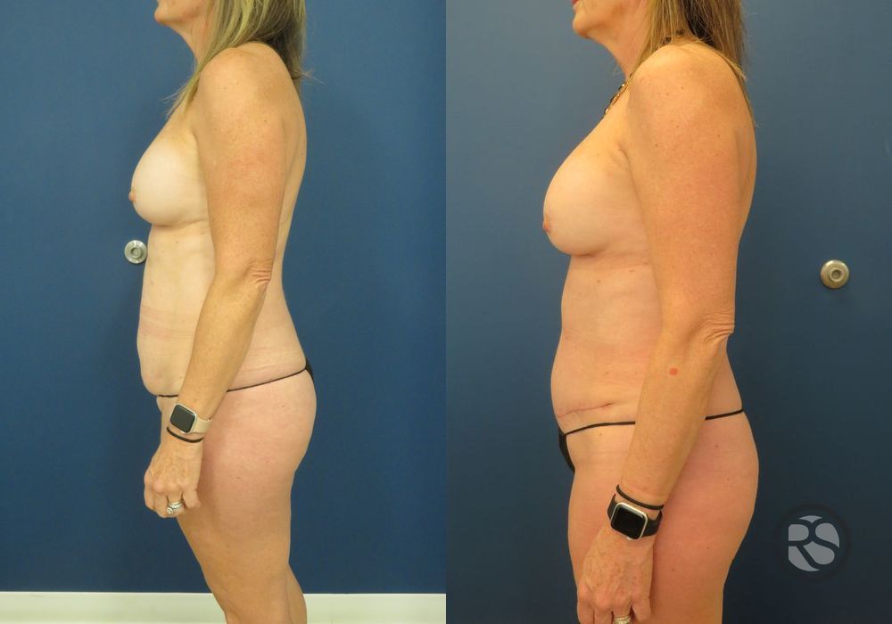 Before photo - Angle 5