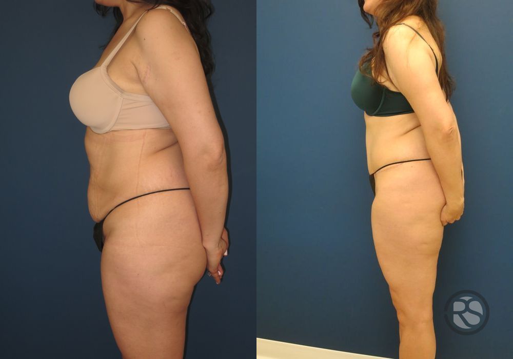 Before photo - Angle 5