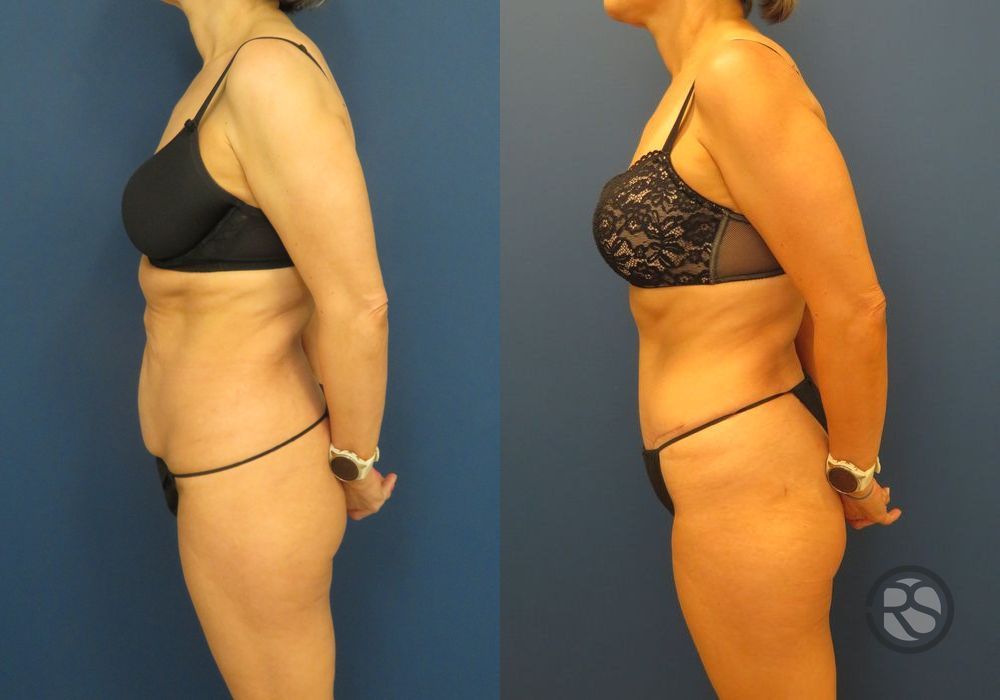 Before photo - Angle 5