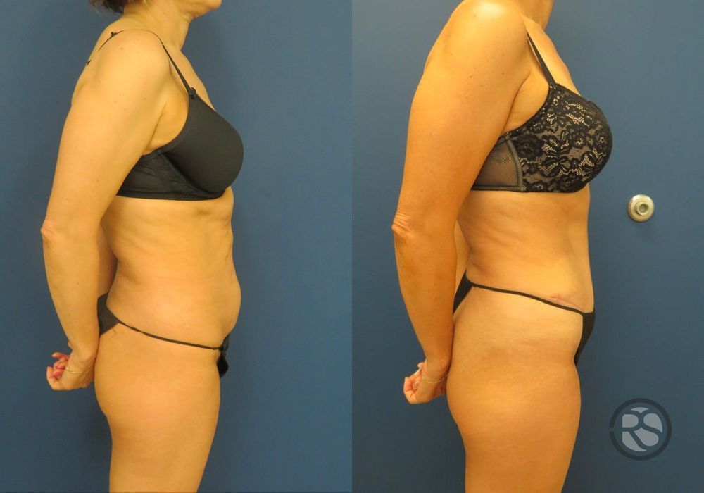 Before photo - Angle 3