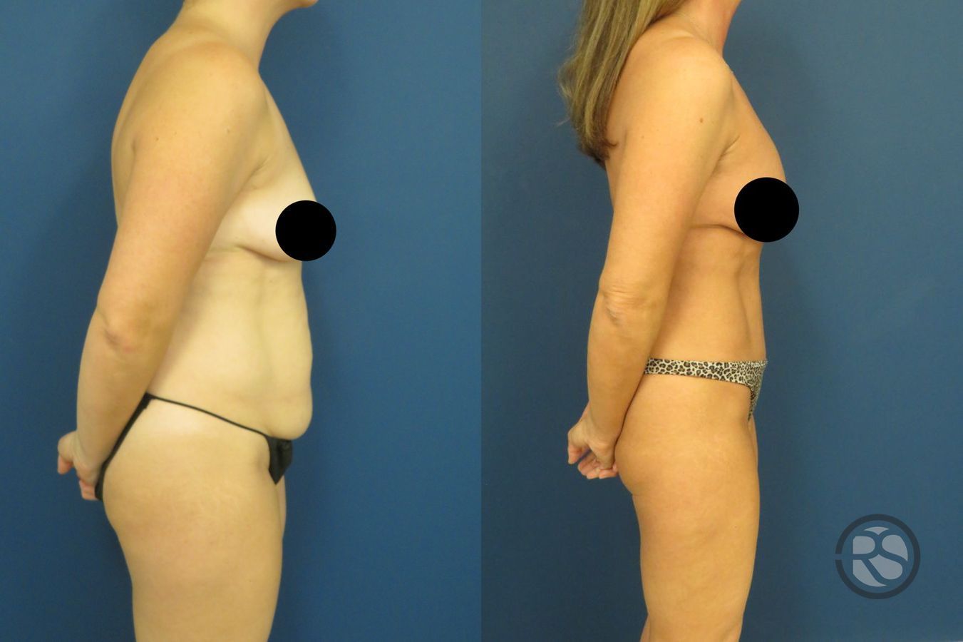 Before and after Tummy Tuck (Abdominoplasty) case 49632 - Angle 2
