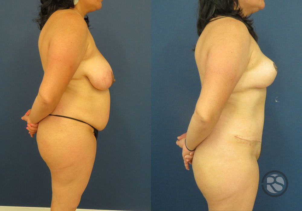 Before photo - Angle 3