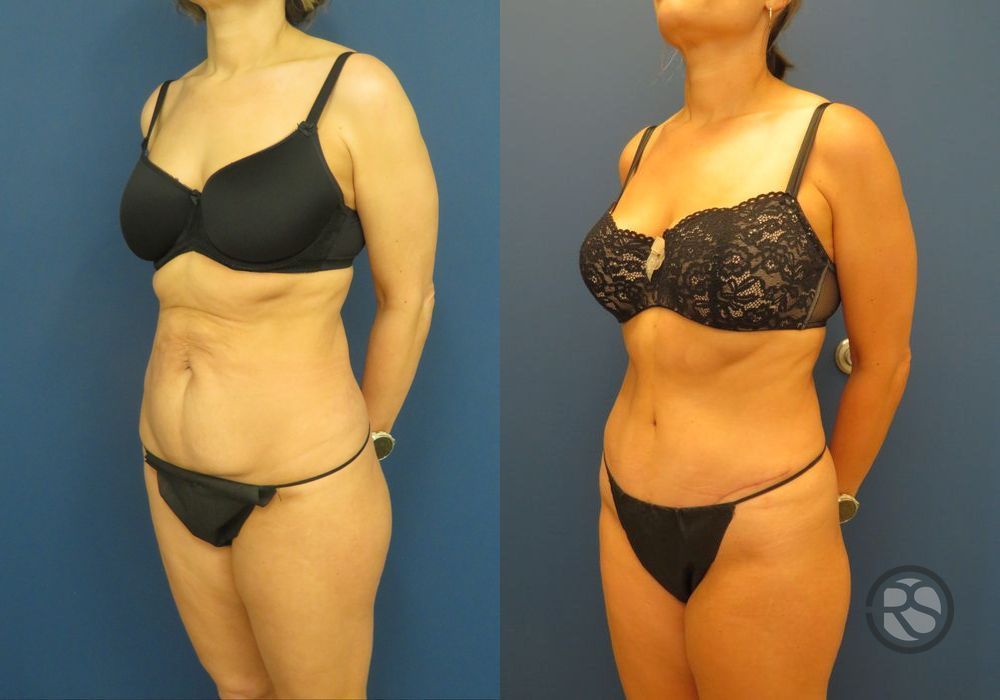 Before photo - Angle 4