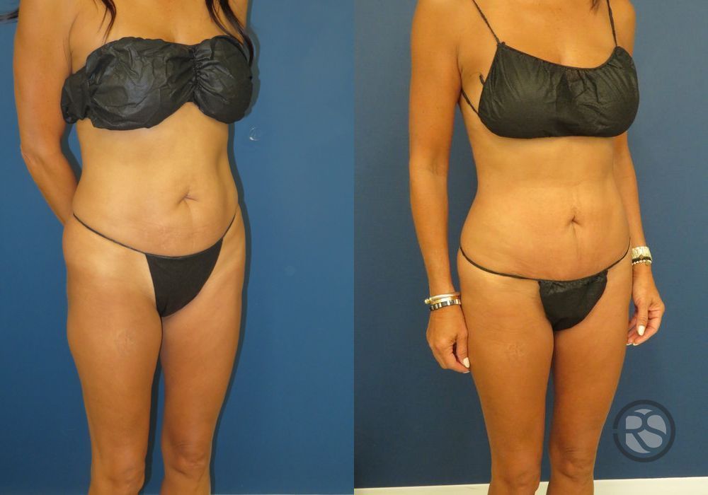 Before photo - Angle 2