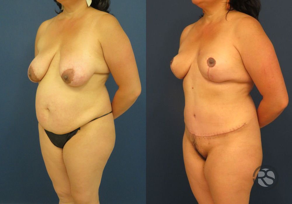 Before photo - Angle 4