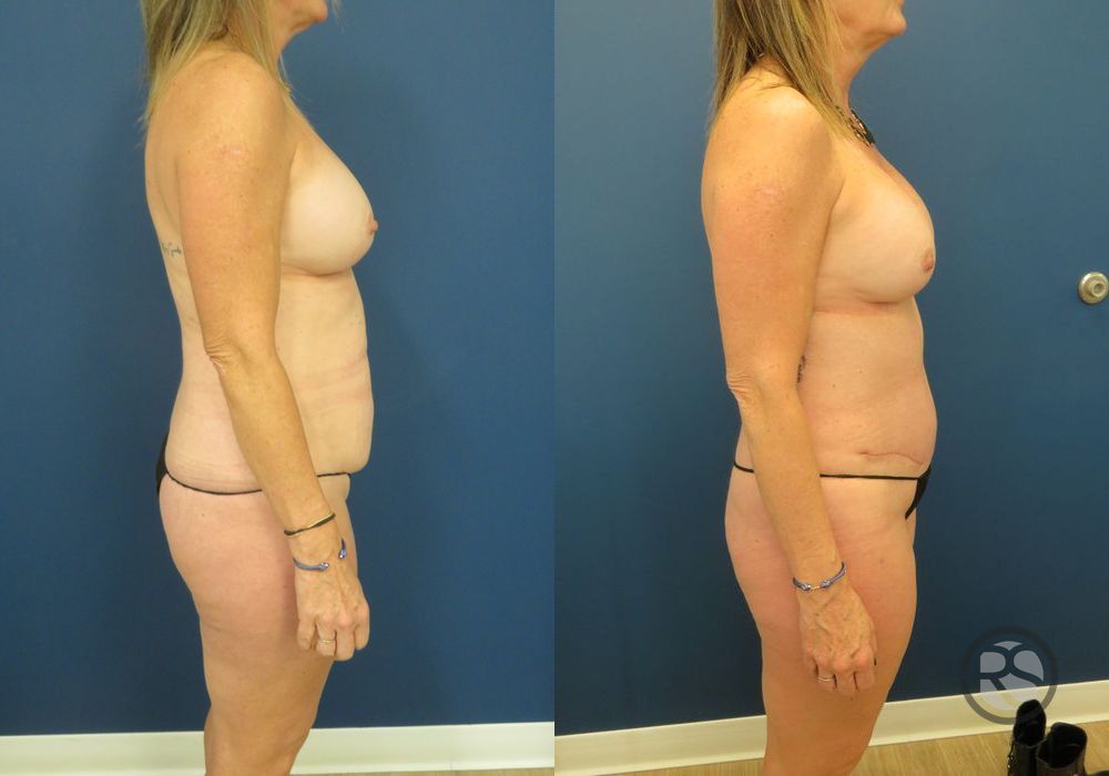 Before photo - Angle 3