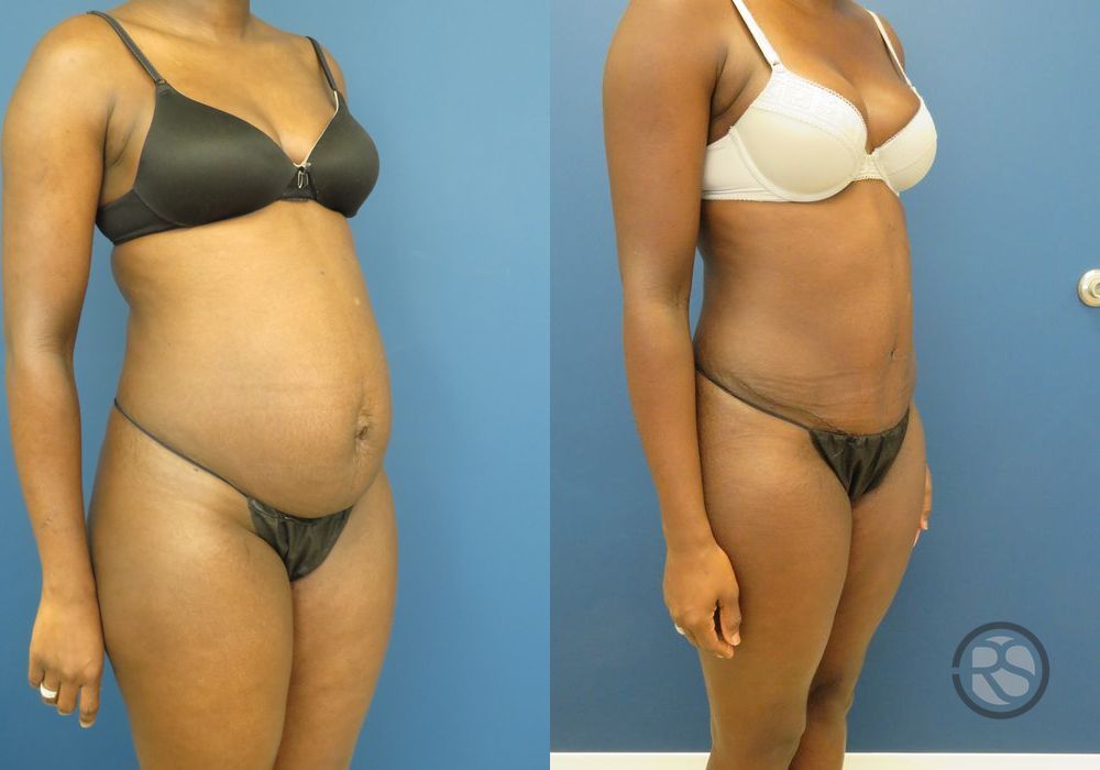 Before photo - Angle 2