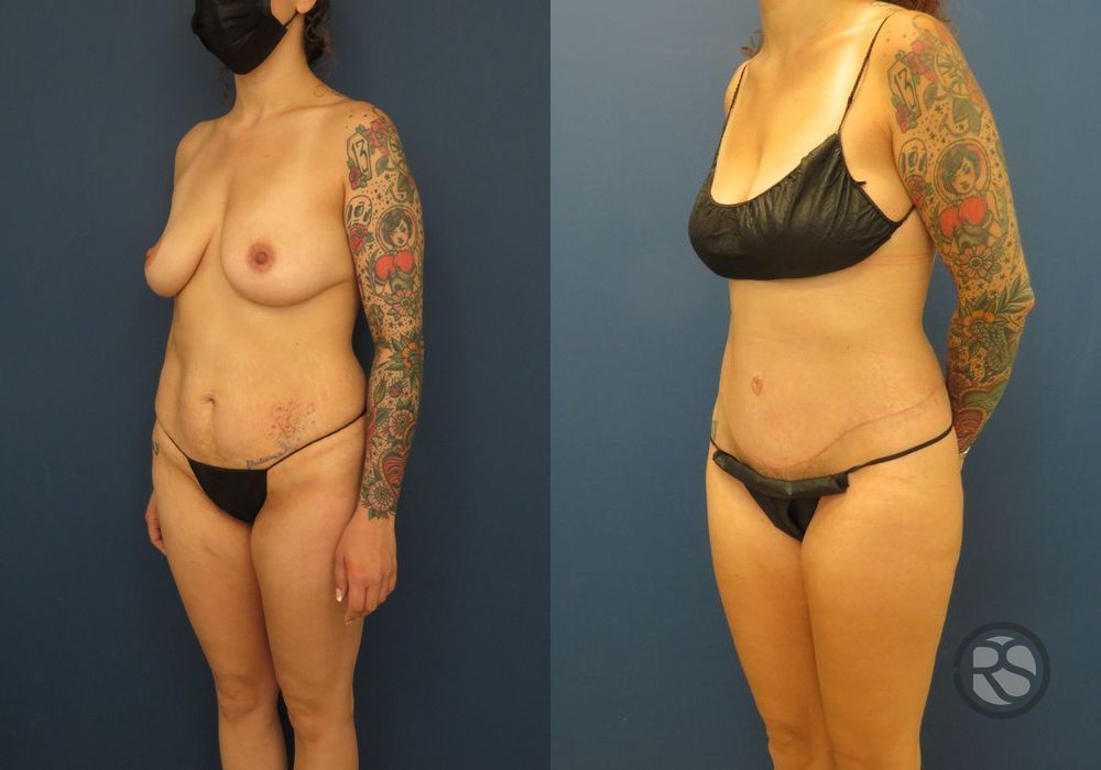 Before photo - Angle 4