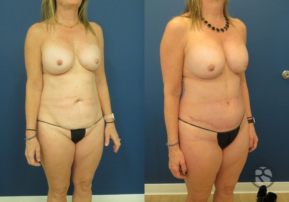 Before photo - Angle 2