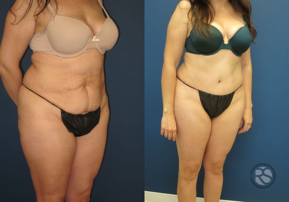 Before photo - Angle 2