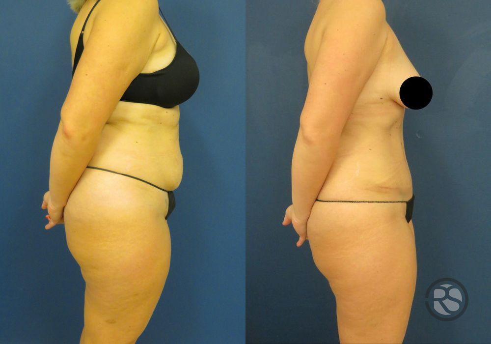 Before photo - Angle 3