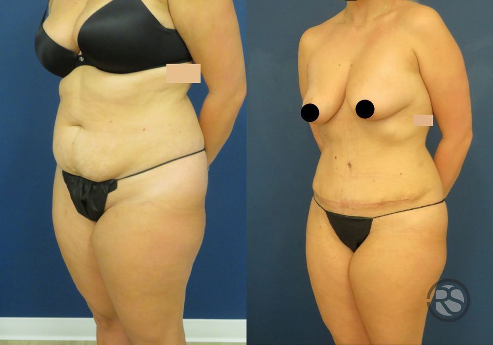 Before photo - Angle 4