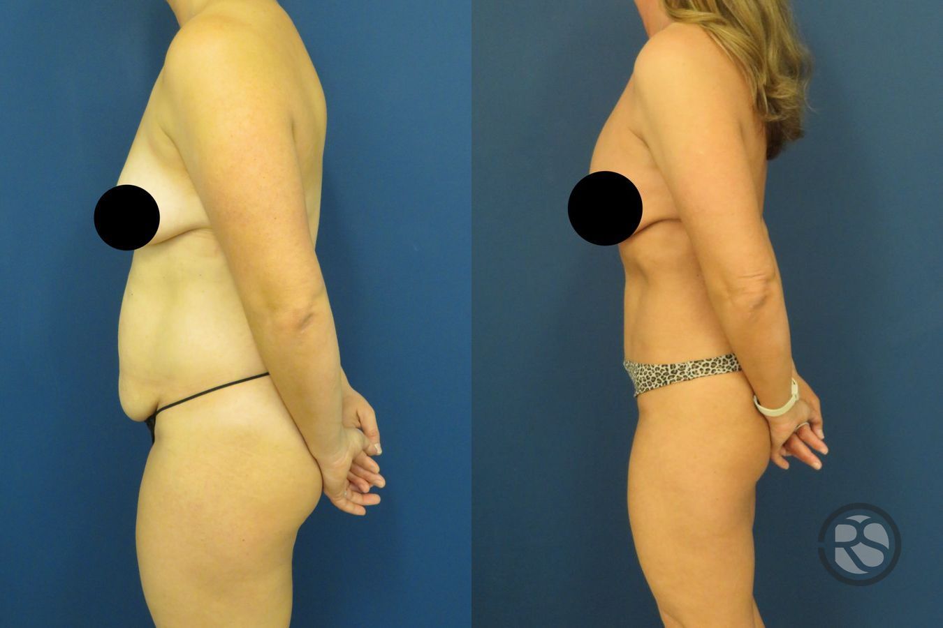 Before and after Tummy Tuck (Abdominoplasty) case 49632 - Angle 5