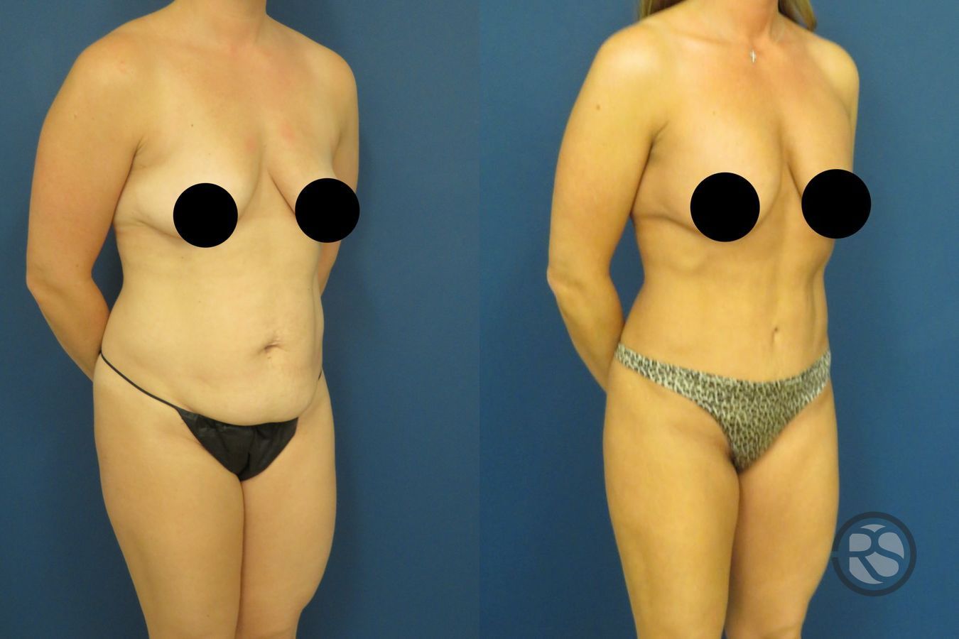 Before and after Tummy Tuck (Abdominoplasty) case 49632 - Angle 3