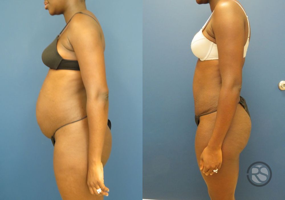 Before photo - Angle 5