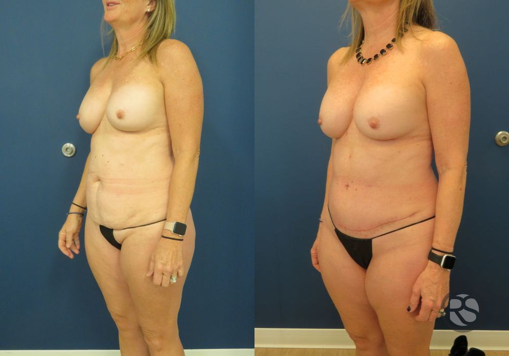 Before photo - Angle 4