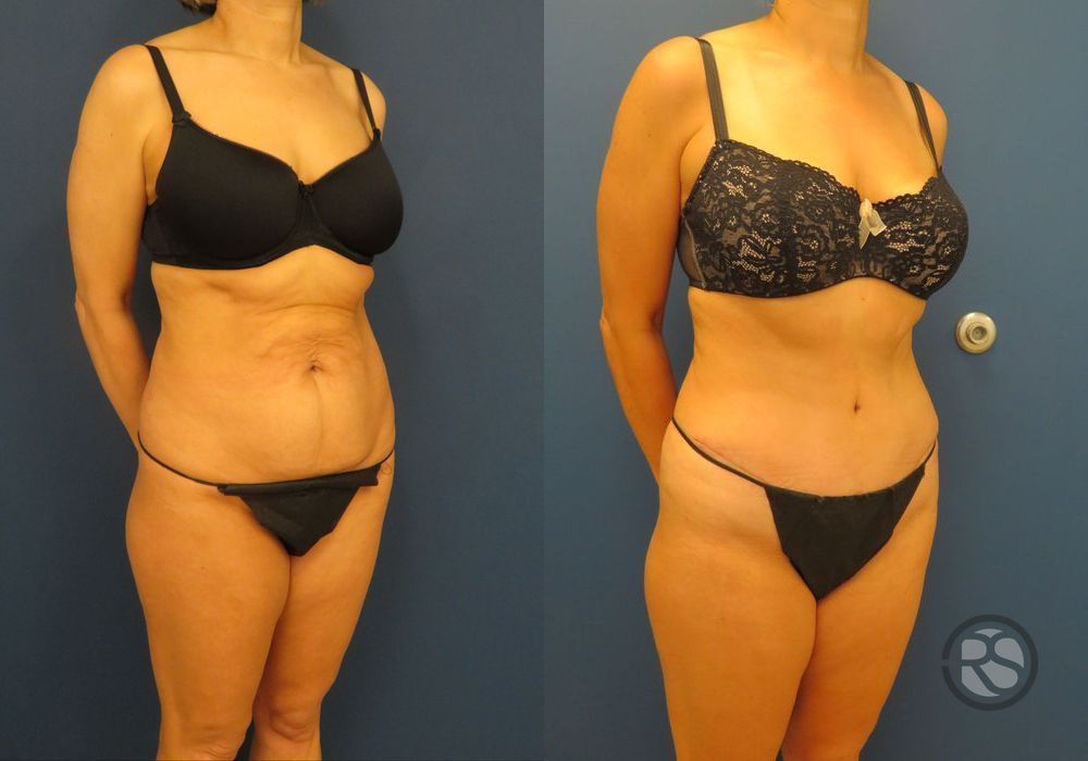 Before photo - Angle 2