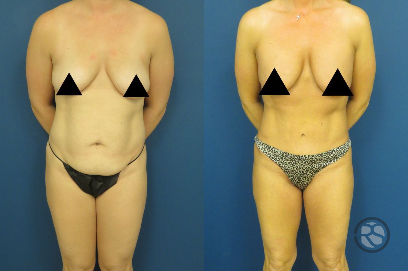 Liposuction