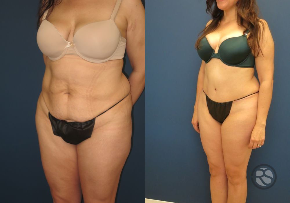 Before photo - Angle 4