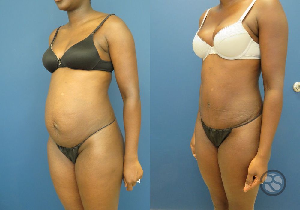 Before photo - Angle 4