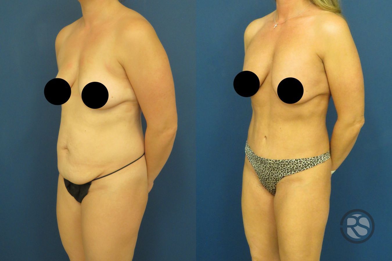Before and after Tummy Tuck (Abdominoplasty) case 49632 - Angle 4