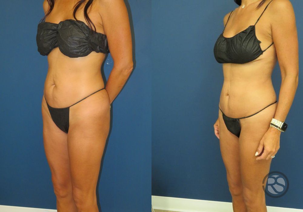 Before photo - Angle 4