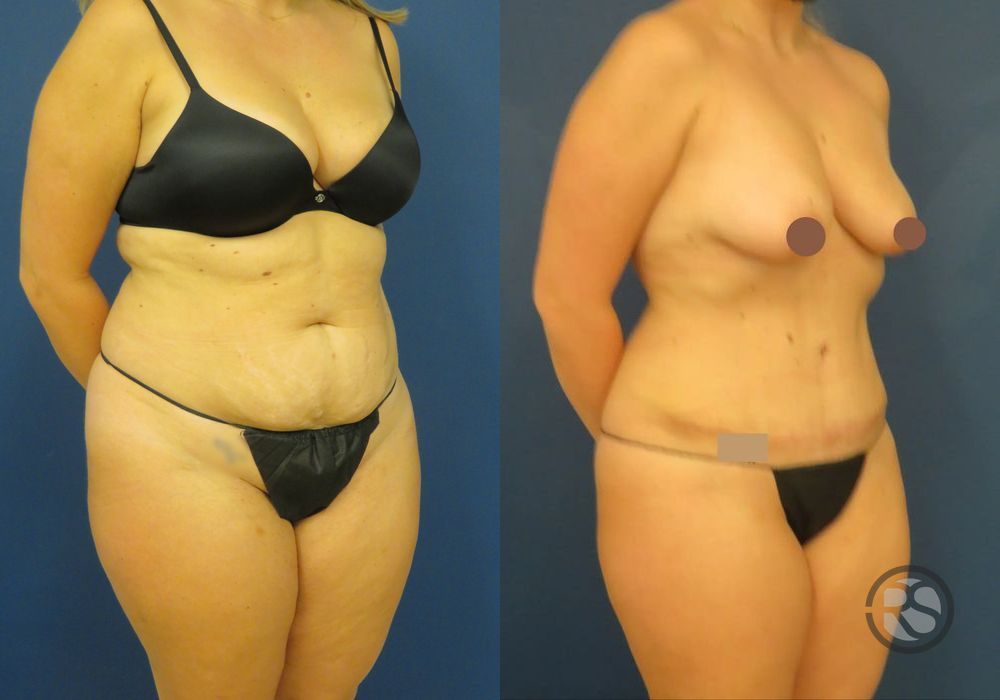 Before photo - Angle 2