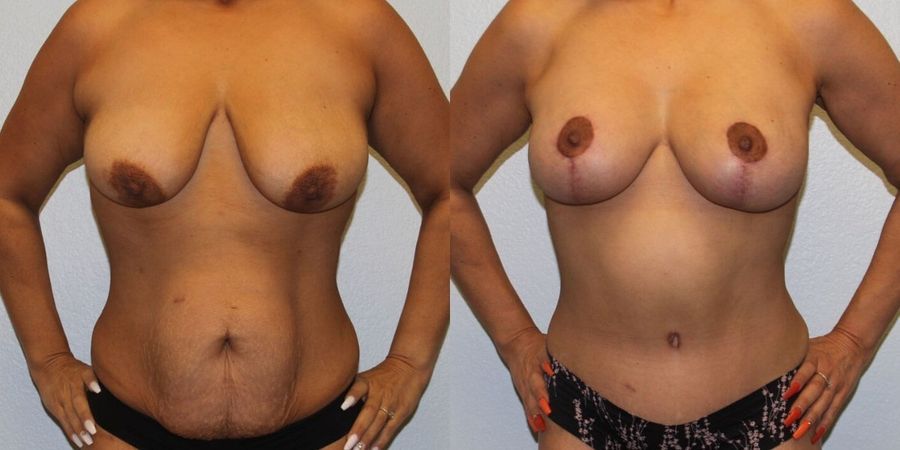 After Weight Loss - Case 19450