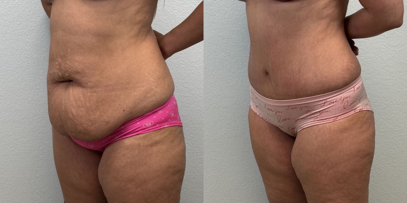 Tummy Tuck - Thumbnail 3