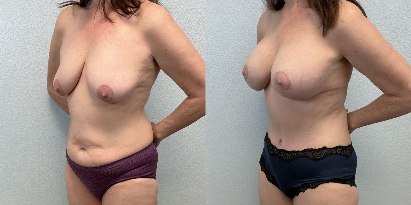 After Weight Loss - Thumbnail 2