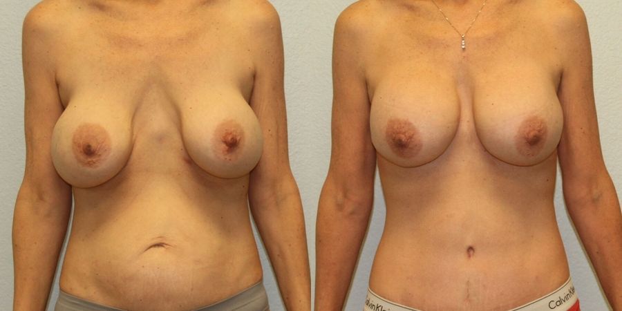 After Weight Loss - Case 19447