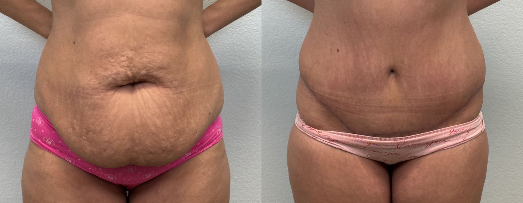 Tummy Tuck - Thumbnail 4