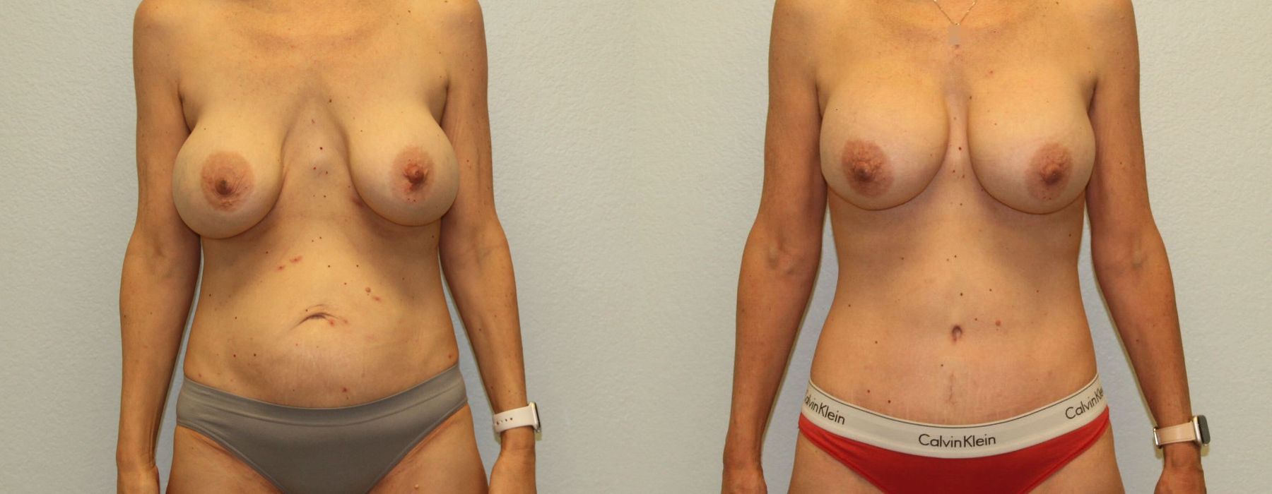 Mommy Makeover - Case 19638